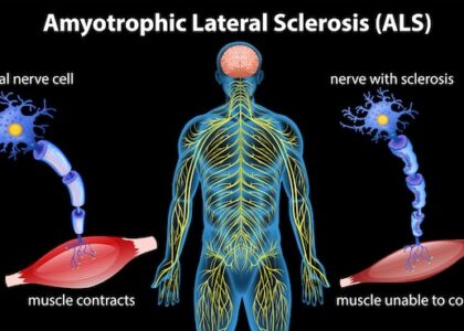 Amyotrophic Lateral Sclerosis Market