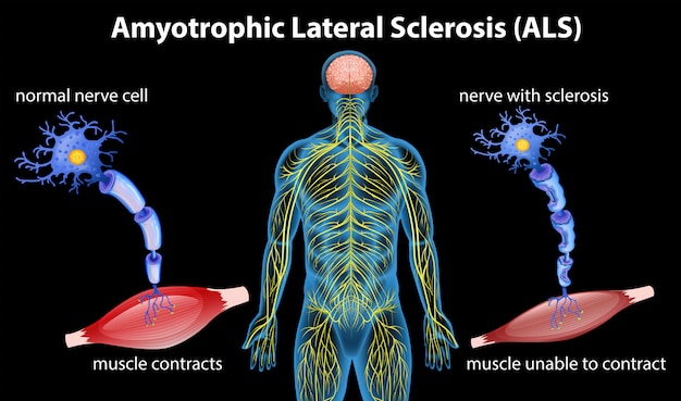 Amyotrophic Lateral Sclerosis Market