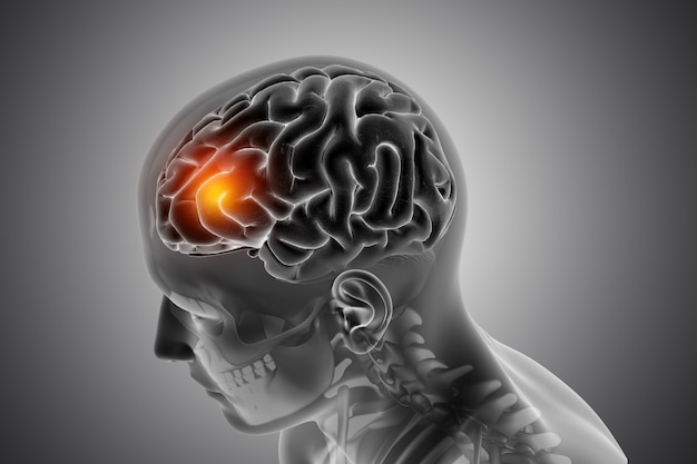 Brain Tumour Drug Market