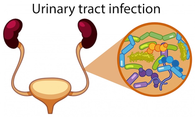 Complicated Urinary Tract Infections Treatment Market