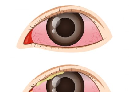 Conjunctivitis Market