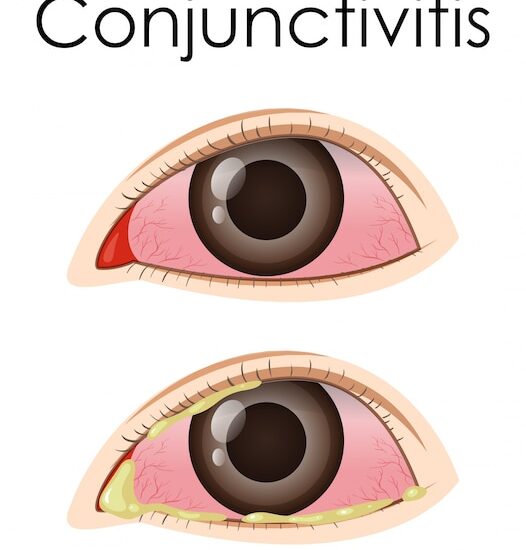 Conjunctivitis Market