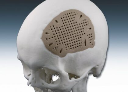 Craniofacial Implants Market