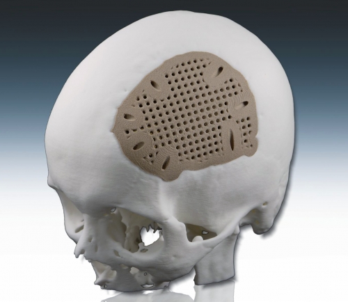 Craniofacial Implants Market