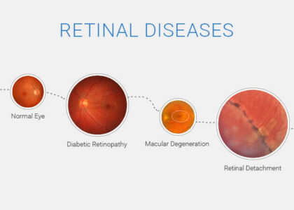 Inherited Retinal Diseases Treatment Market