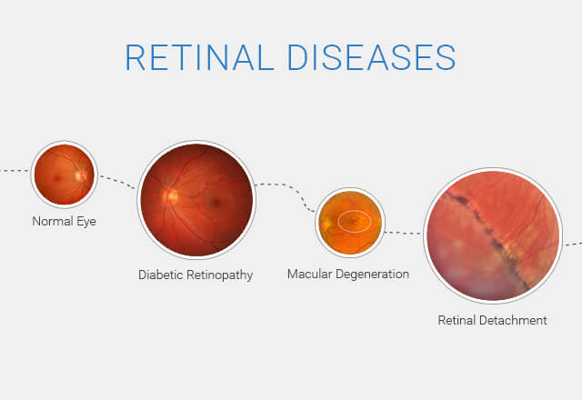 Inherited Retinal Diseases Treatment Market