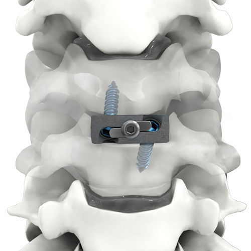 Polyether Ether Ketone (PEEK) Interbody Devices Market