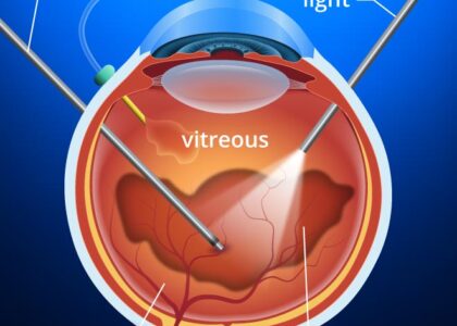 Vitrectomy Devices Market