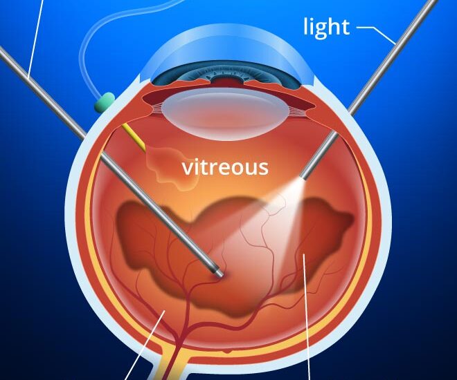 Vitrectomy Devices Market