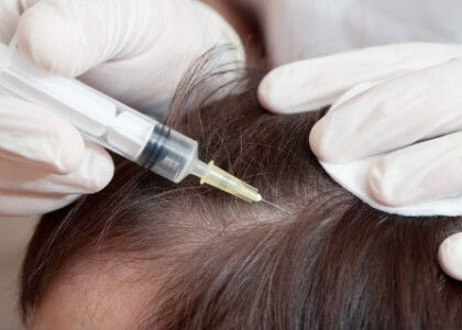 Alopecia Treatment Market