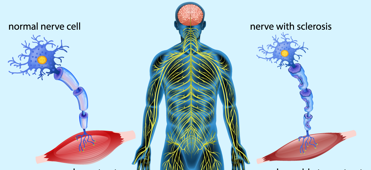 Amyotrophic Lateral Sclerosis Market