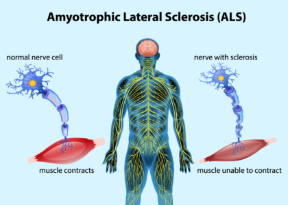 Amyotrophic Lateral Sclerosis Market