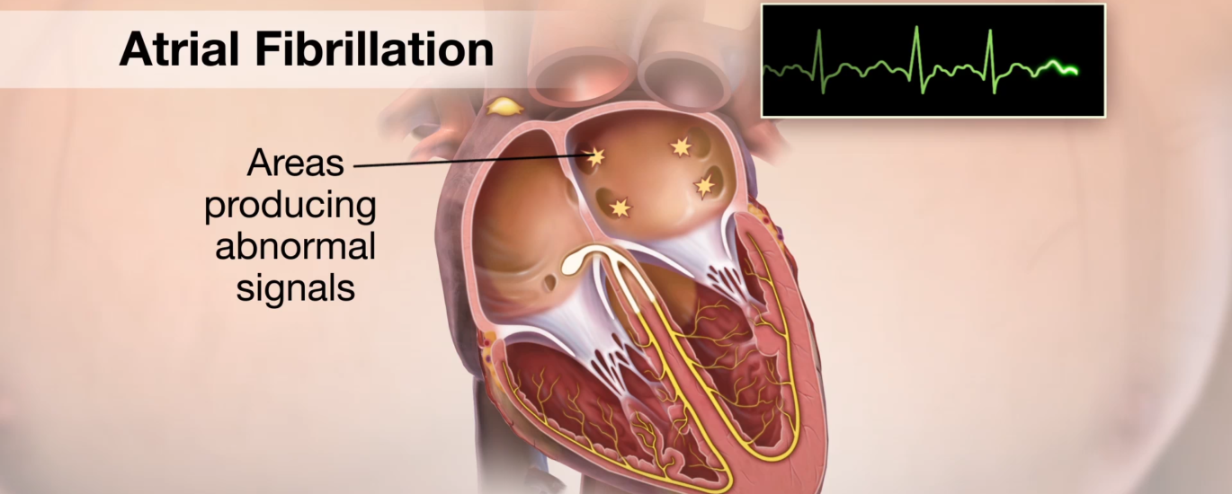 Atrial Appendage Occluder Market