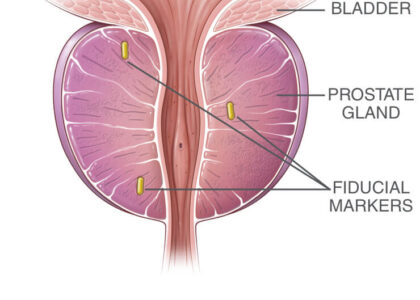 Fiducial Markers Market