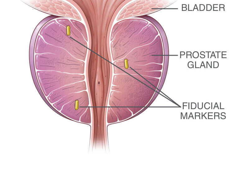 Fiducial Markers Market