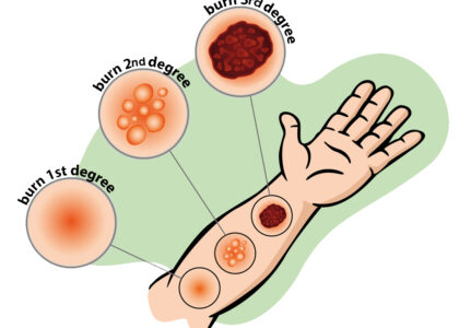 Burns Treatment Market