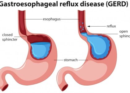 Gastroesophageal Reflux Disease (GERD) Devices Market