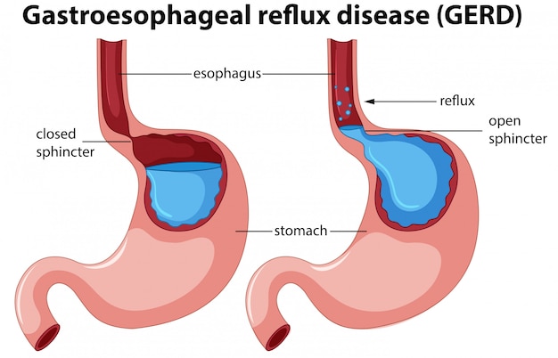 Gastroesophageal Reflux Disease (GERD) Devices Market