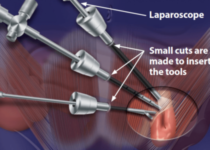 Hernia Repair Devices Market