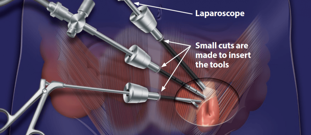 Hernia Repair Devices Market