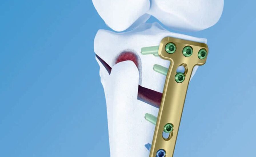 High Tibial Osteotomy Plates Market