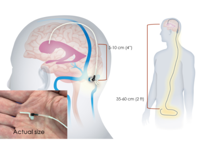 Hydrocephalus Shunt Market