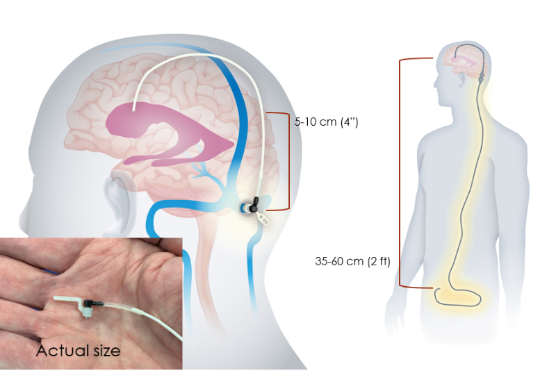 Hydrocephalus Shunt Market