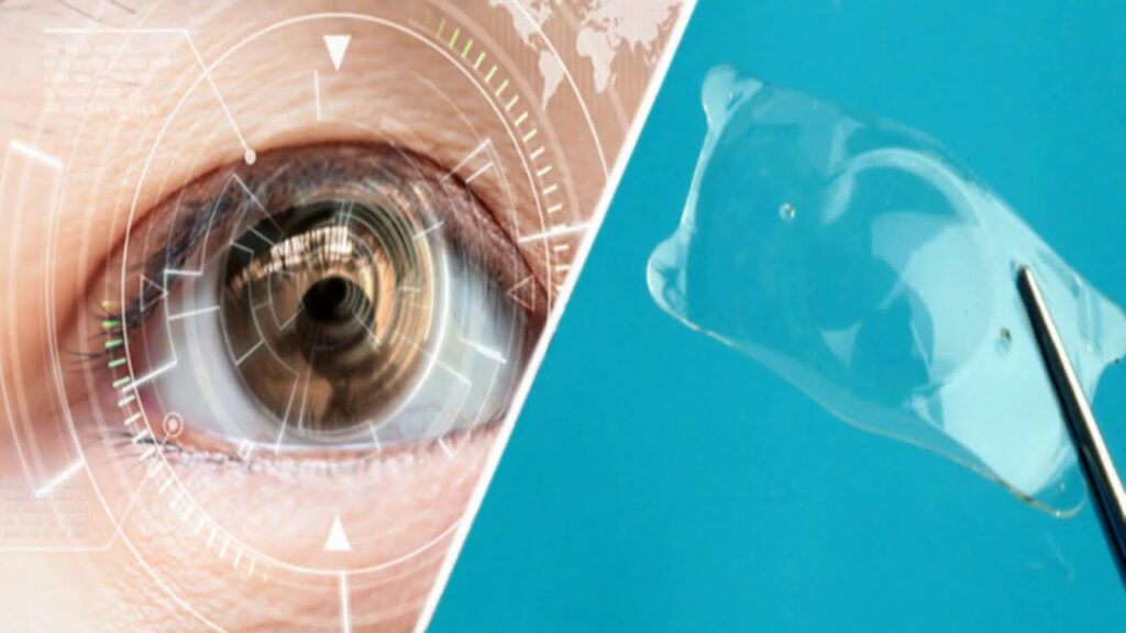 Implantable Collamer Lens Market