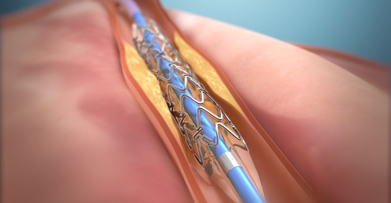 India Coronary Stent Market