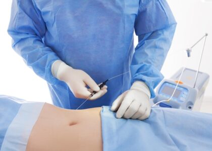 Liposuction Market