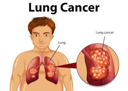 Lung Cancer Therapeutics Market