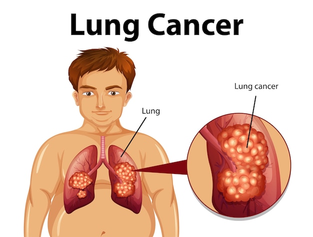 Lung Cancer Therapeutics Market