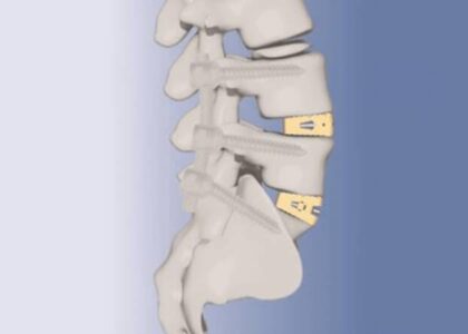 Medical Polyetheretherketone Market