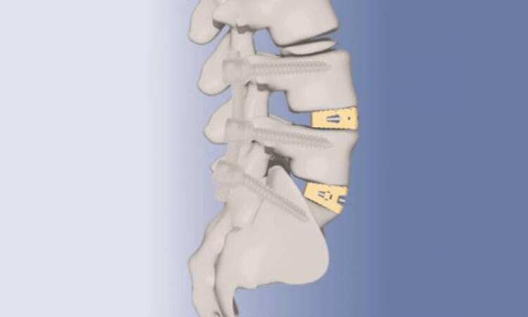 Medical Polyetheretherketone Market