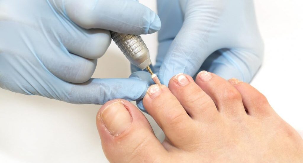 Onychomycosis Treatment Market