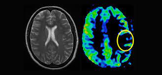 Perfusion Imaging Market