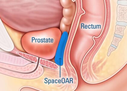 Prostate Cancer Market