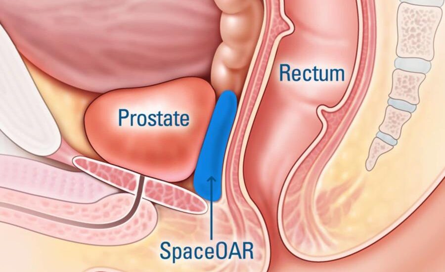 Prostate Cancer Market