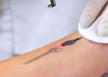 Tattoo Removal Laser Market