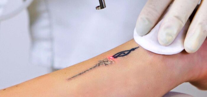 Tattoo Removal Laser Market