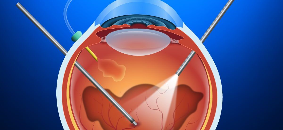 Vitrectomy Devices Market