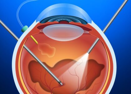 Vitrectomy Devices Market