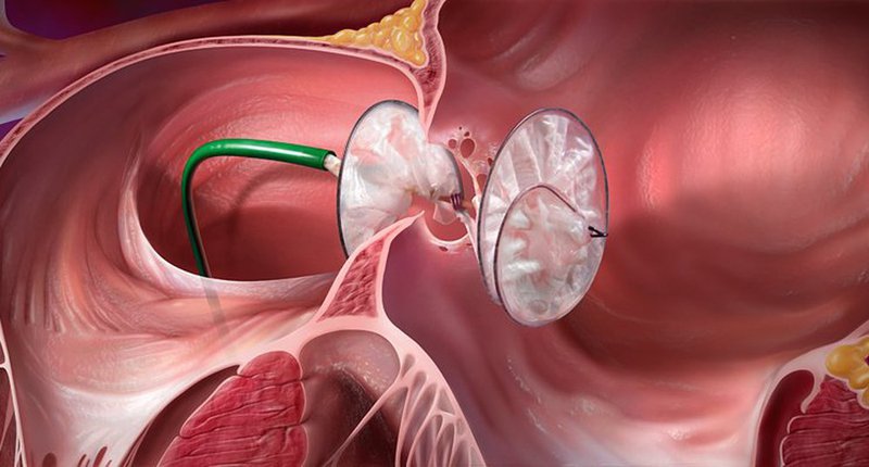 Anorectal Malformation Treatment Market