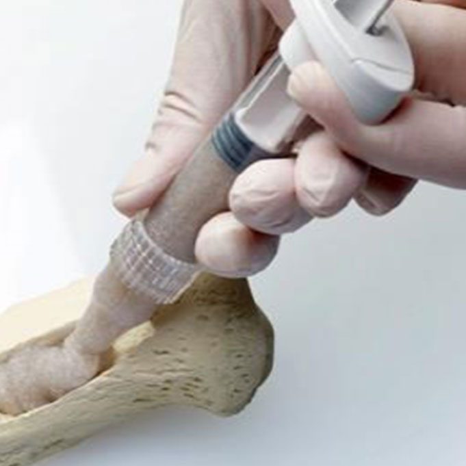 Bone Grafts and Substitutes Market