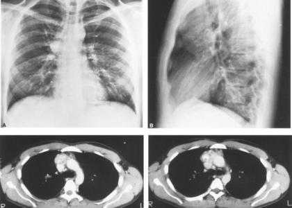 Chronic Granulomatous Disease (CGD) Management Market