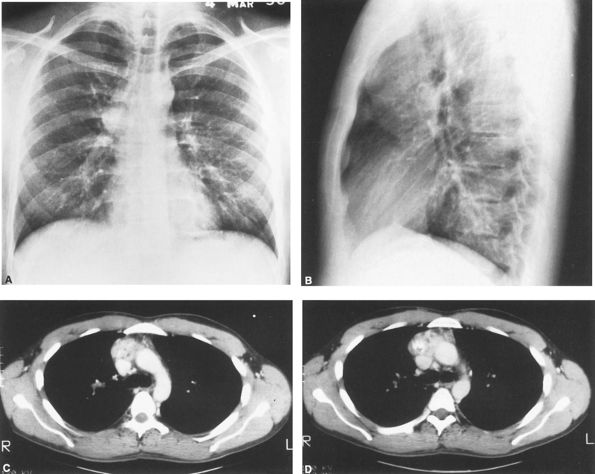 Chronic Granulomatous Disease (CGD) Management Market