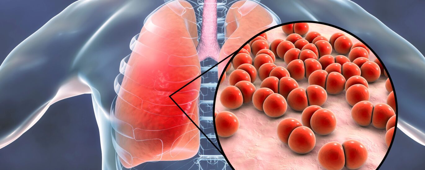 Community Acquired Bacterial Pneumonia (CABP) Treatment Market