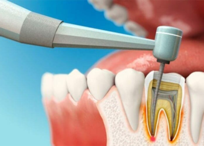 Dental Caries and Endodontic Market
