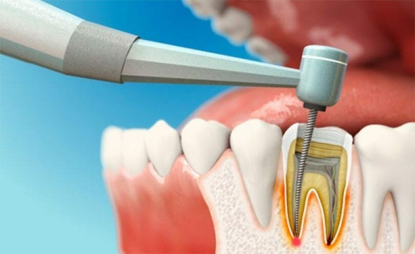 Dental Caries and Endodontic Market