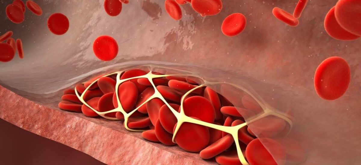 Disseminated Intravascular Coagulation (DIC) Treatment Market